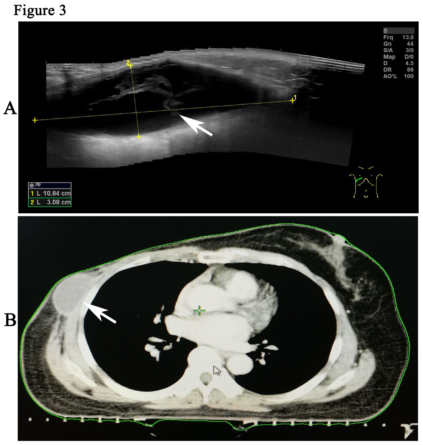 Serious Infection of Chest Wall during Radiotherapy in Breast Cancer ...